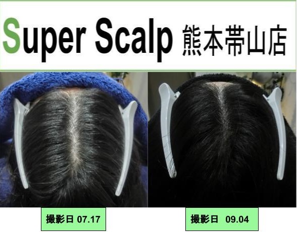30代女性の薄毛も必ず改善されます スーパースカルプ発毛センター熊本