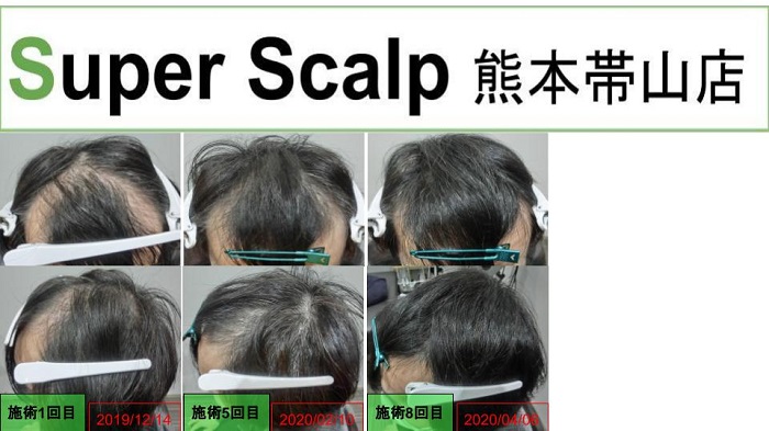30代 40代 男性 女性の薄毛 Agaを改善 スーパースカルプ発毛センター熊本